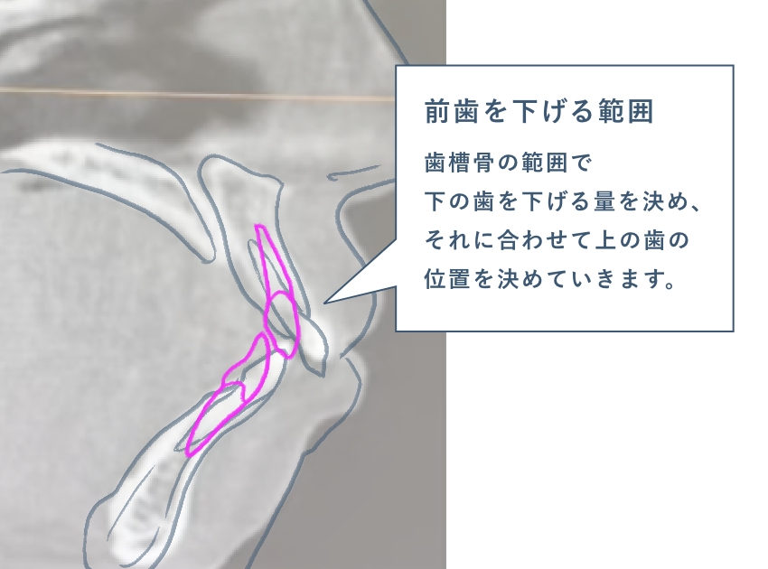 前歯を下げるには限度がある