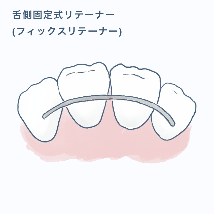 舌側固定式リテーナー（フィックスリテーナー）