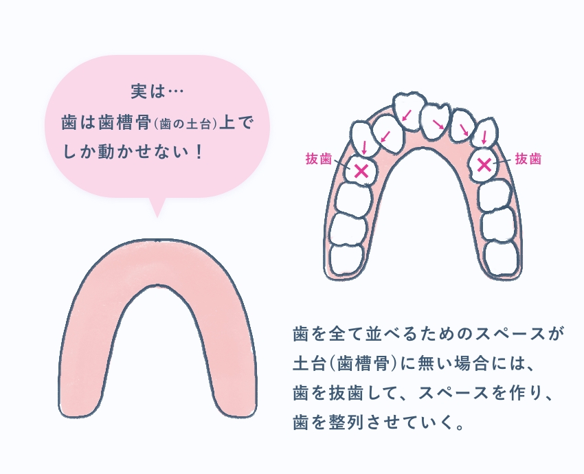 抜歯が必要な例