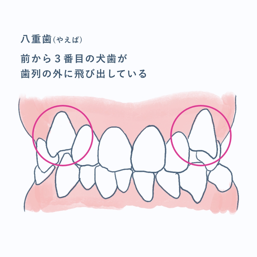 八重歯(やえば)