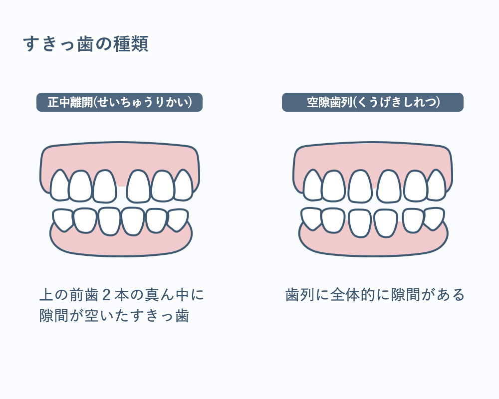 すきっ歯の種類