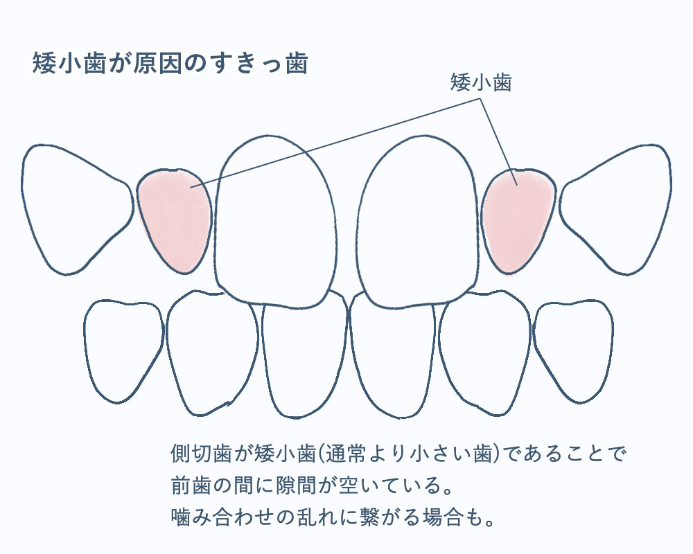 側切歯の矮小歯・欠損歯とすきっ歯
