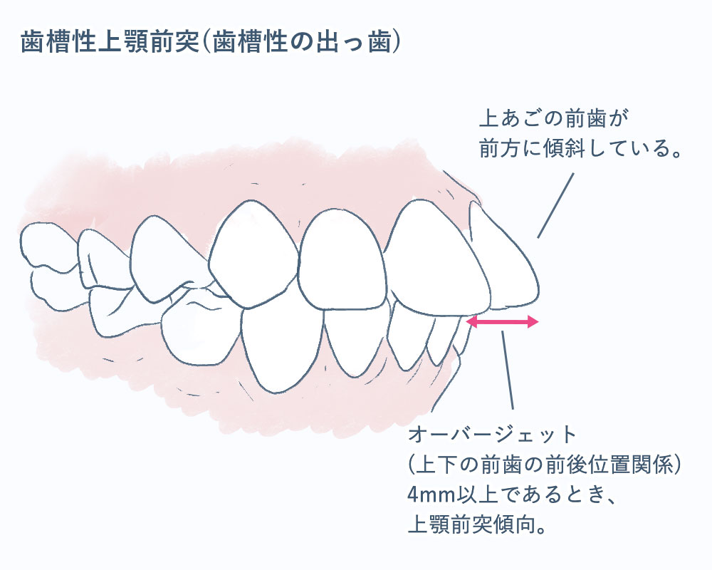歯槽性の上顎前突・出っ歯