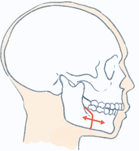 下顎枝矢状分割術または下顎枝垂直骨切り術