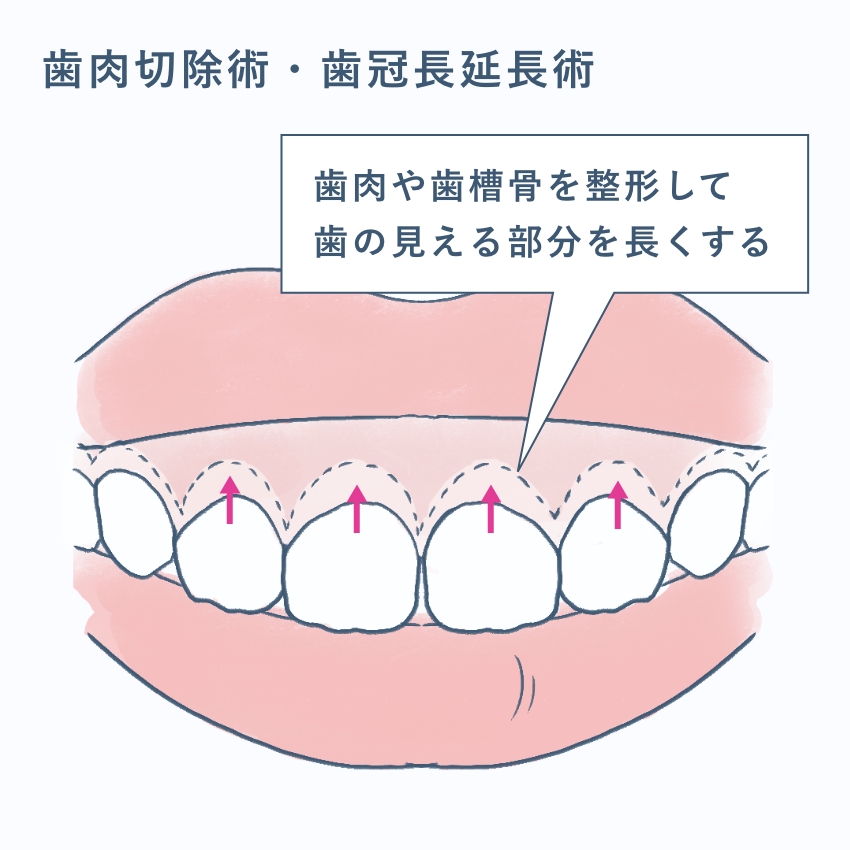 歯を長くする手術