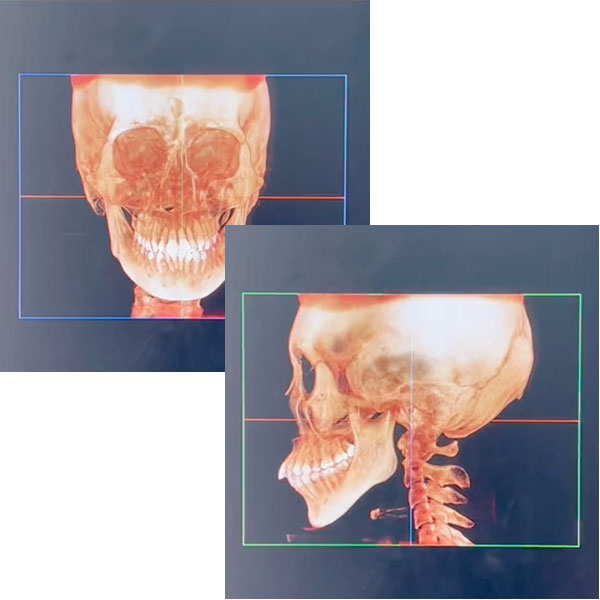 頭部の3DCT