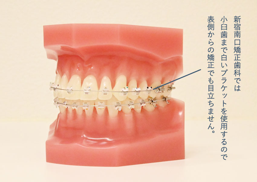 小臼歯から前歯にかけて白いブラケットを使用